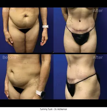 Before and after: Tummy Tuck, Dr. Thomas McNemar