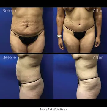 Before and after: Tummy Tuck, Dr. Thomas McNemar