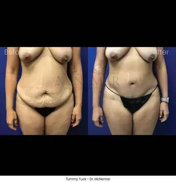 Before and after: Tummy Tuck, Dr. Thomas McNemar