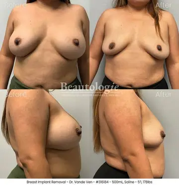 Before and after: Implant Removal, Dr. Heather Vande Ven