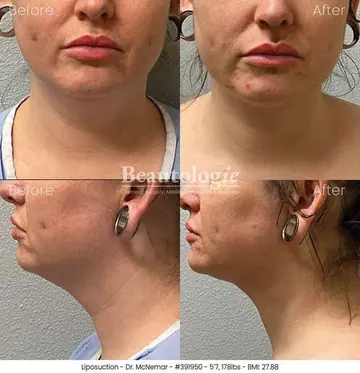 Before and after: Liposuction, Dr. Thomas McNemar