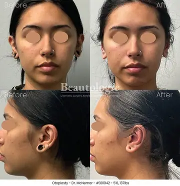 Before and after: Otoplasty, Dr. Thomas McNemar