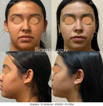 Before and after: Otoplasty, Dr. Thomas McNemar