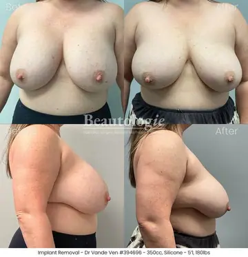 Before and after: Implant Removal, Dr. Heather Vande Ven