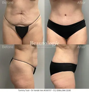 Before and after: Tummy Tuck, Dr. Heather Vande Ven