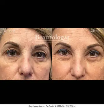 Before and after: Eyelid Surgery, Dr. Bryan Curtis