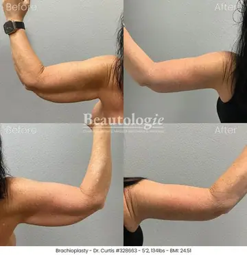 Before and after: Arm Lift, Dr. Bryan Curtis