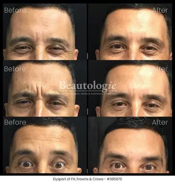 Before and after: Dysport