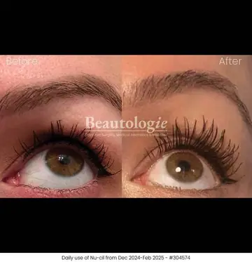 Before and after: Obagi Nu-Cil