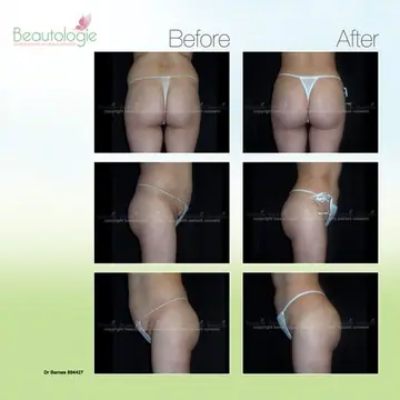 Before and after: Buttock Augmentations, Dr. Zach Barnes