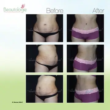 Before and after: Tummy Tuck, Dr. Zach Barnes
