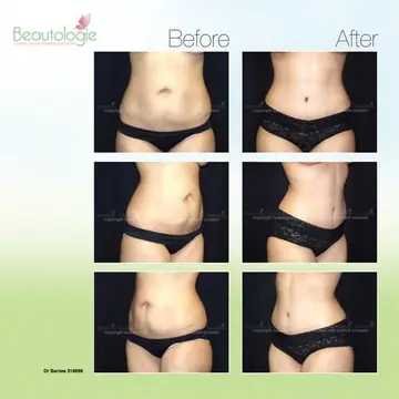Before and after: Tummy Tuck, Dr. Zach Barnes