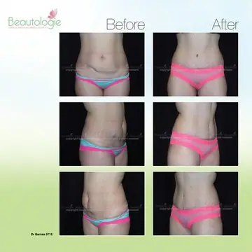 Before and after: Tummy Tuck, Dr. Zach Barnes