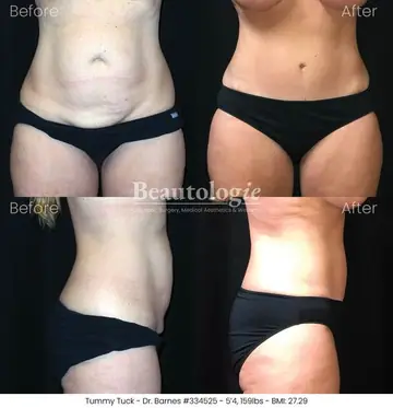 Before and after: Tummy Tuck, Dr. Zach Barnes