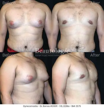 Before and after: Gynecomastia, Dr. Zach Barnes