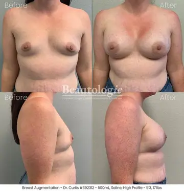 Before and after: Breast Augmentation, Dr. Bryan Curtis