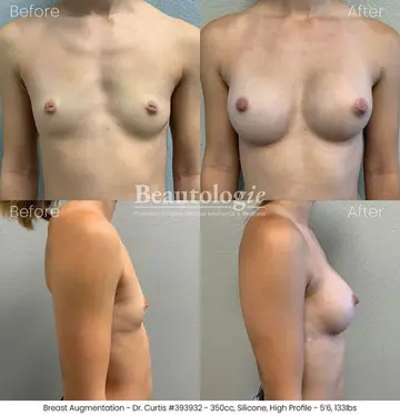 Before and after: Breast Augmentation, Dr. Bryan Curtis