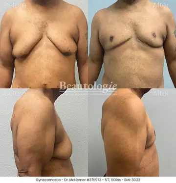 Before and after: Gynecomastia, Dr. Thomas McNemar