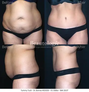 Before and after: Tummy Tuck, Dr. Zach Barnes