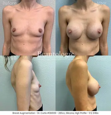 Before and after: Breast Augmentation, Dr. Bryan Curtis