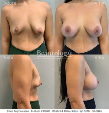 Before and after: Breast Augmentation, Dr. Bryan Curtis