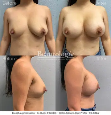 Before and after: Breast Augmentation, Dr. Bryan Curtis