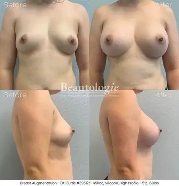 Before and after: Breast Augmentation, Dr. Bryan Curtis